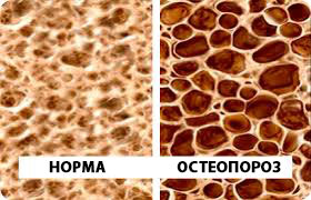 Остеопороз недостаток кальция в организме